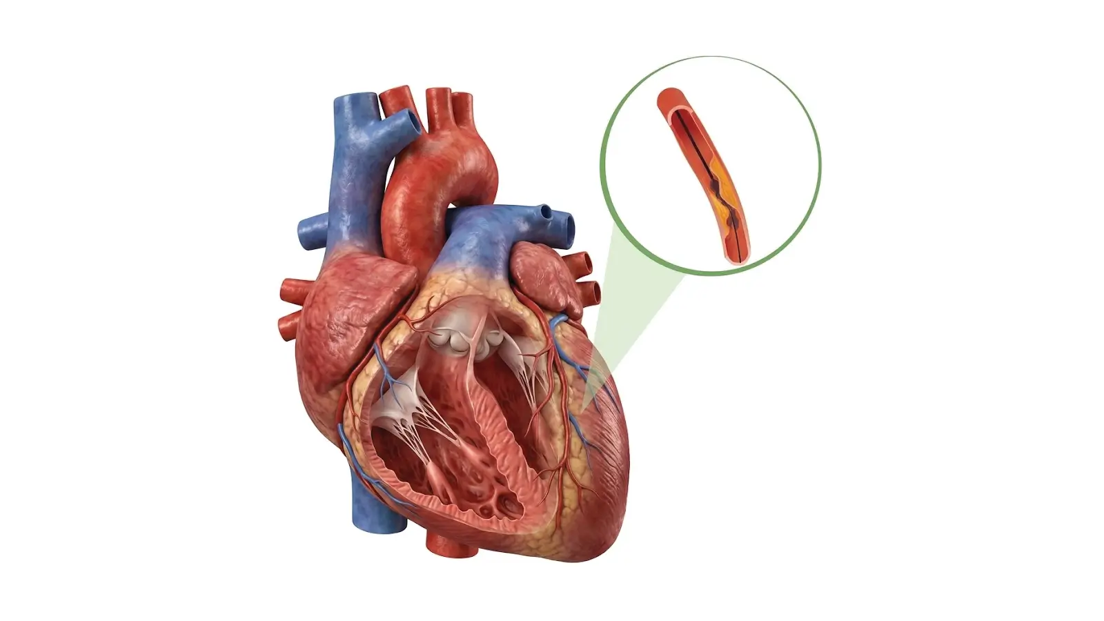 Coronary Angiogram